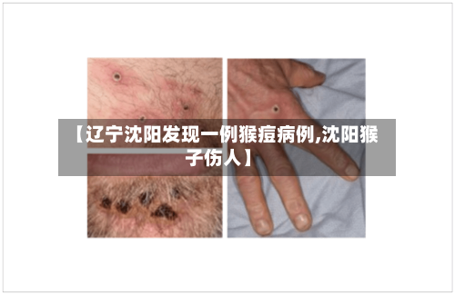 【辽宁沈阳发现一例猴痘病例,沈阳猴子伤人】-第2张图片